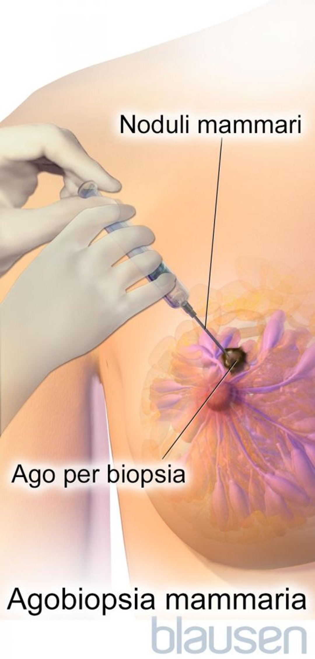 Agobiopsia mammaria