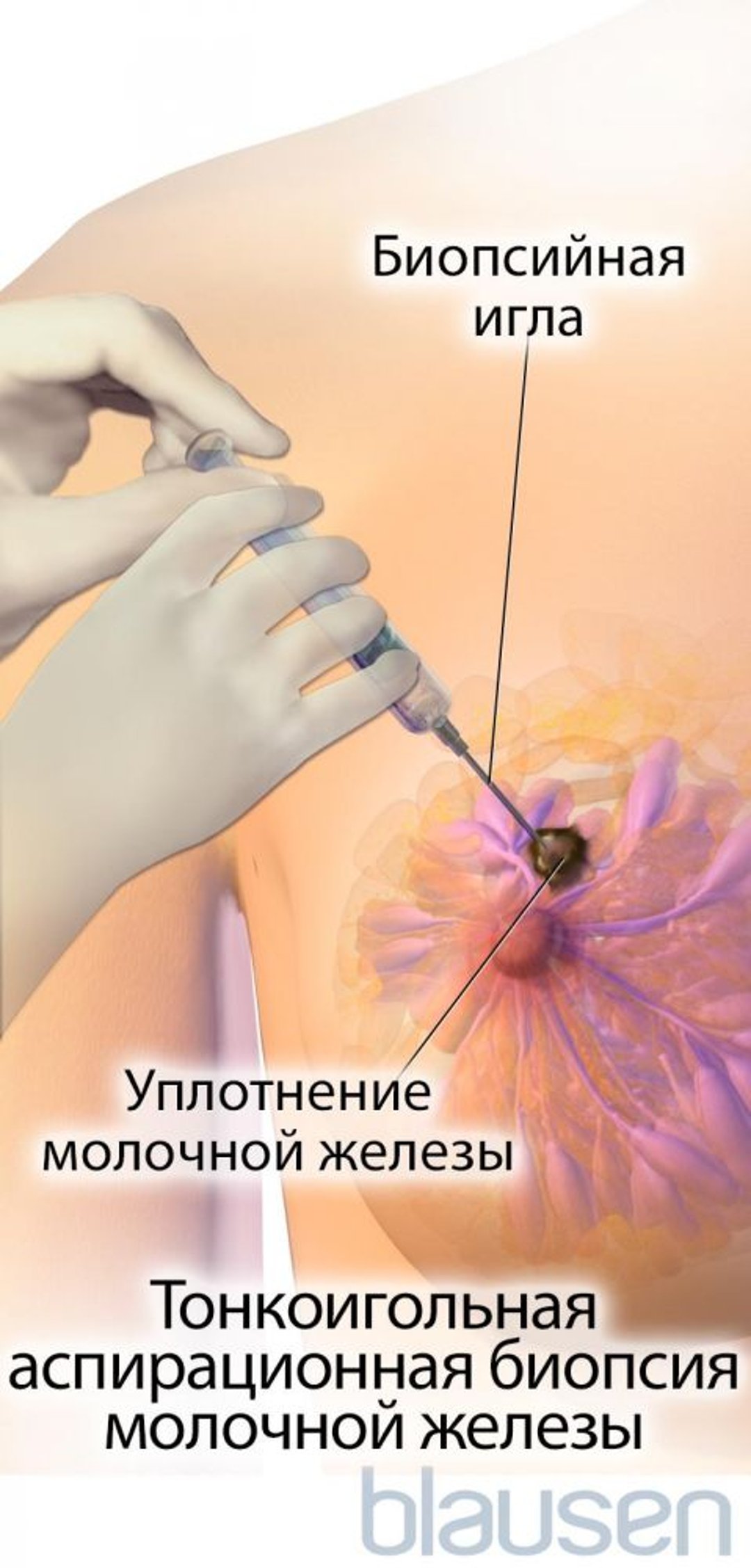 Тонкоигольная аспирационная биопсия молочной железы