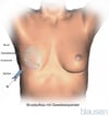 Expander zur Brustrekonstruktion