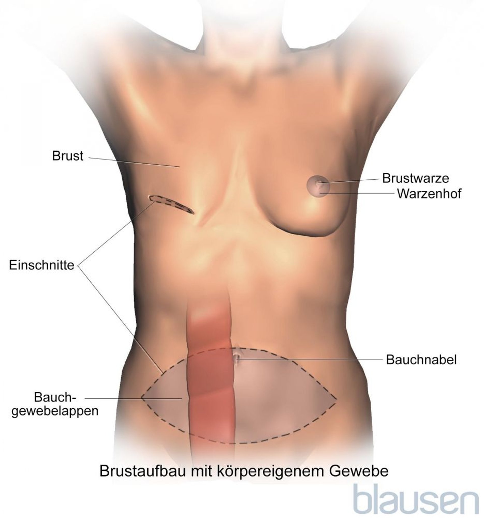 Rekonstruktion der Brust mit der TRAM-Lappenplastik (transversaler Rectus-abdominis-Muskel)