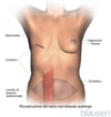 Ricostruzione mammaria mediante la procedura con lembo cutaneo (flap) del muscolo retto addominale trasverso (Transverse Rectus Abdominis Muscle, TRAM).