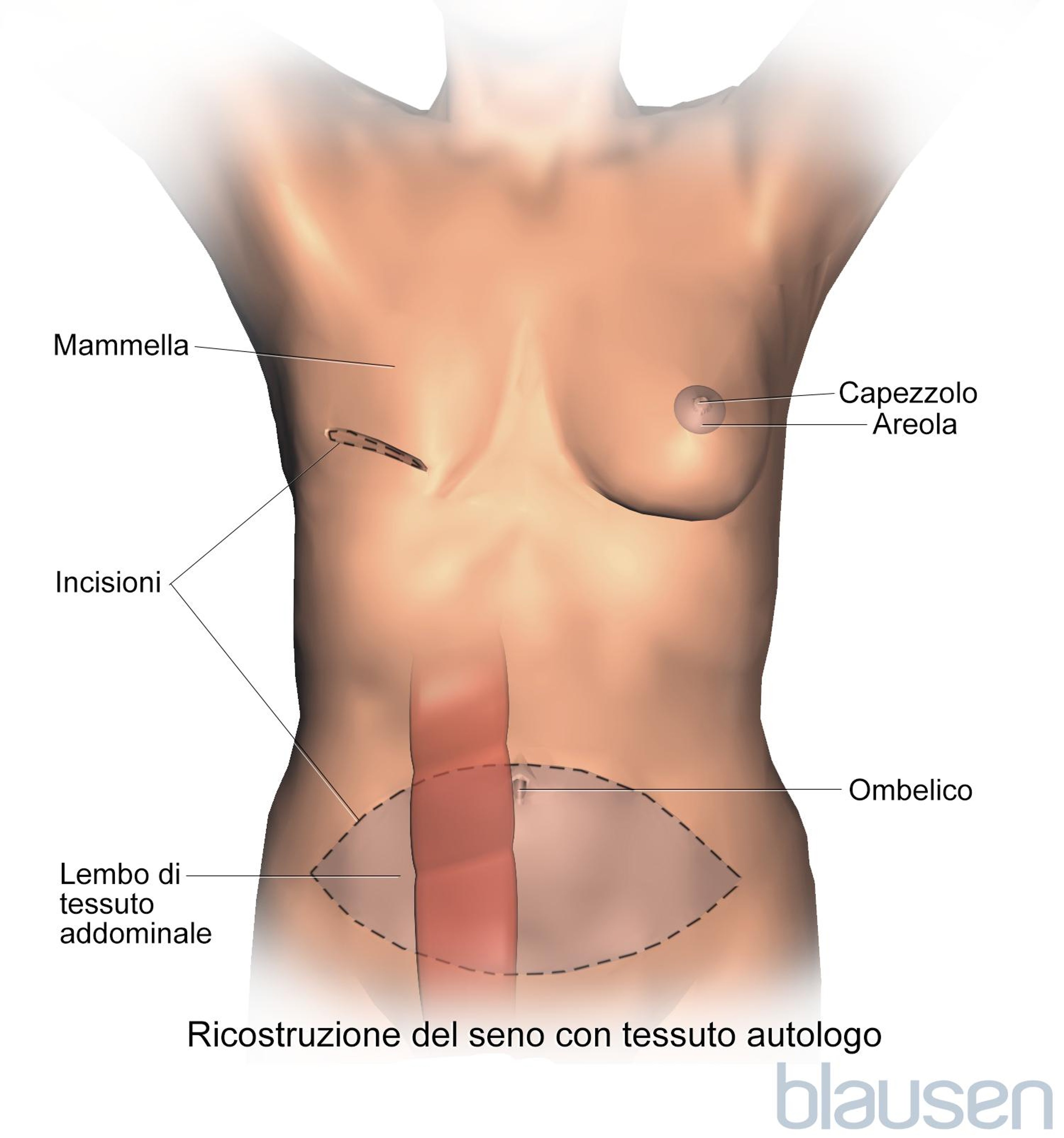 Ricostruzione mammaria mediante la procedura con lembo cutaneo (flap) del muscolo retto addominale trasverso (Transverse Rectus Abdominis Muscle, TRAM).