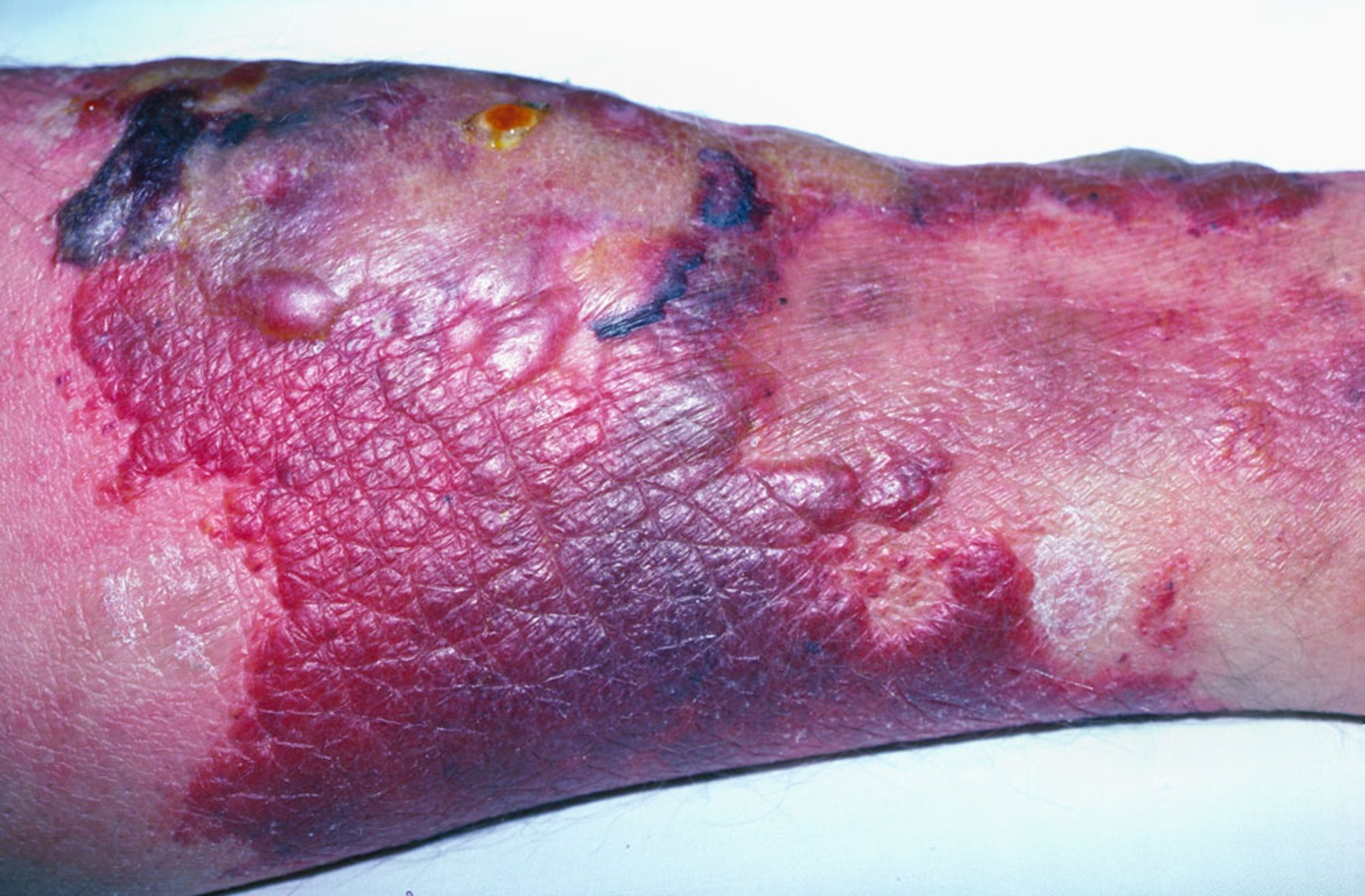 Bullous Erysipelas