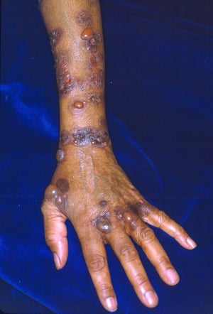 Bullous Pemphigoid on the Arm and Hand