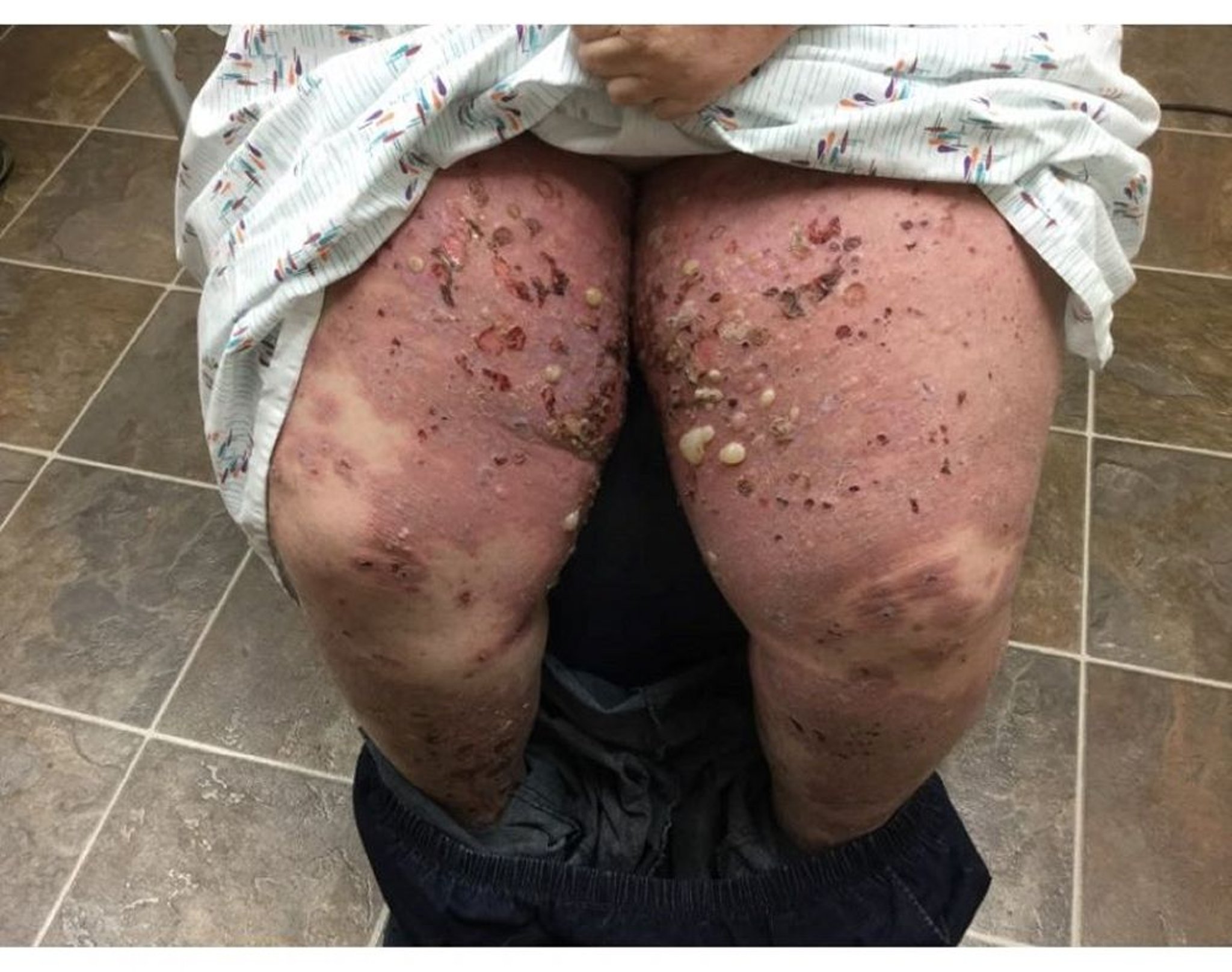 Pemfigoide bolloso sulle gambe