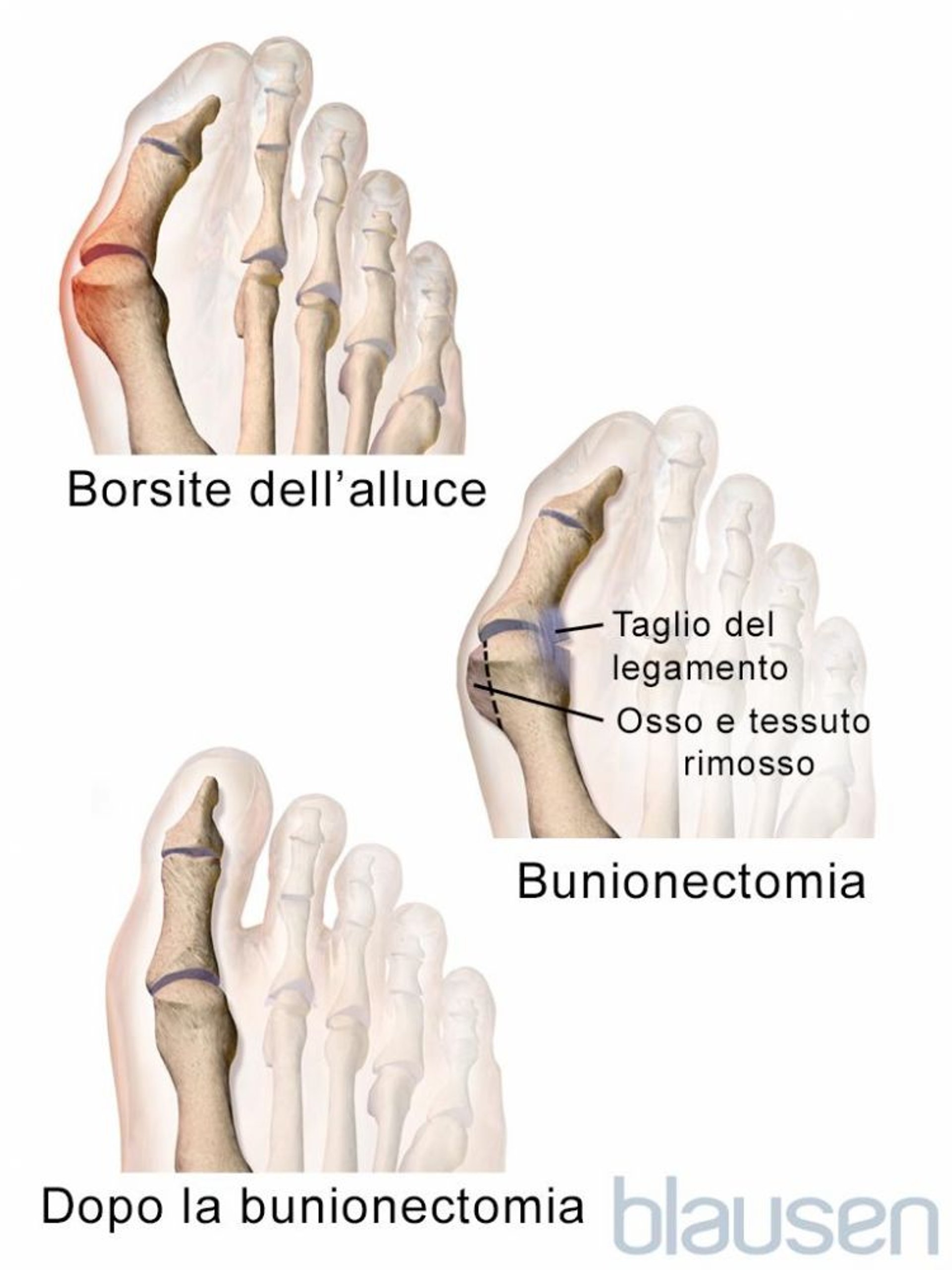 Bunionectomia