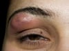 Furoncle sous un sourcil