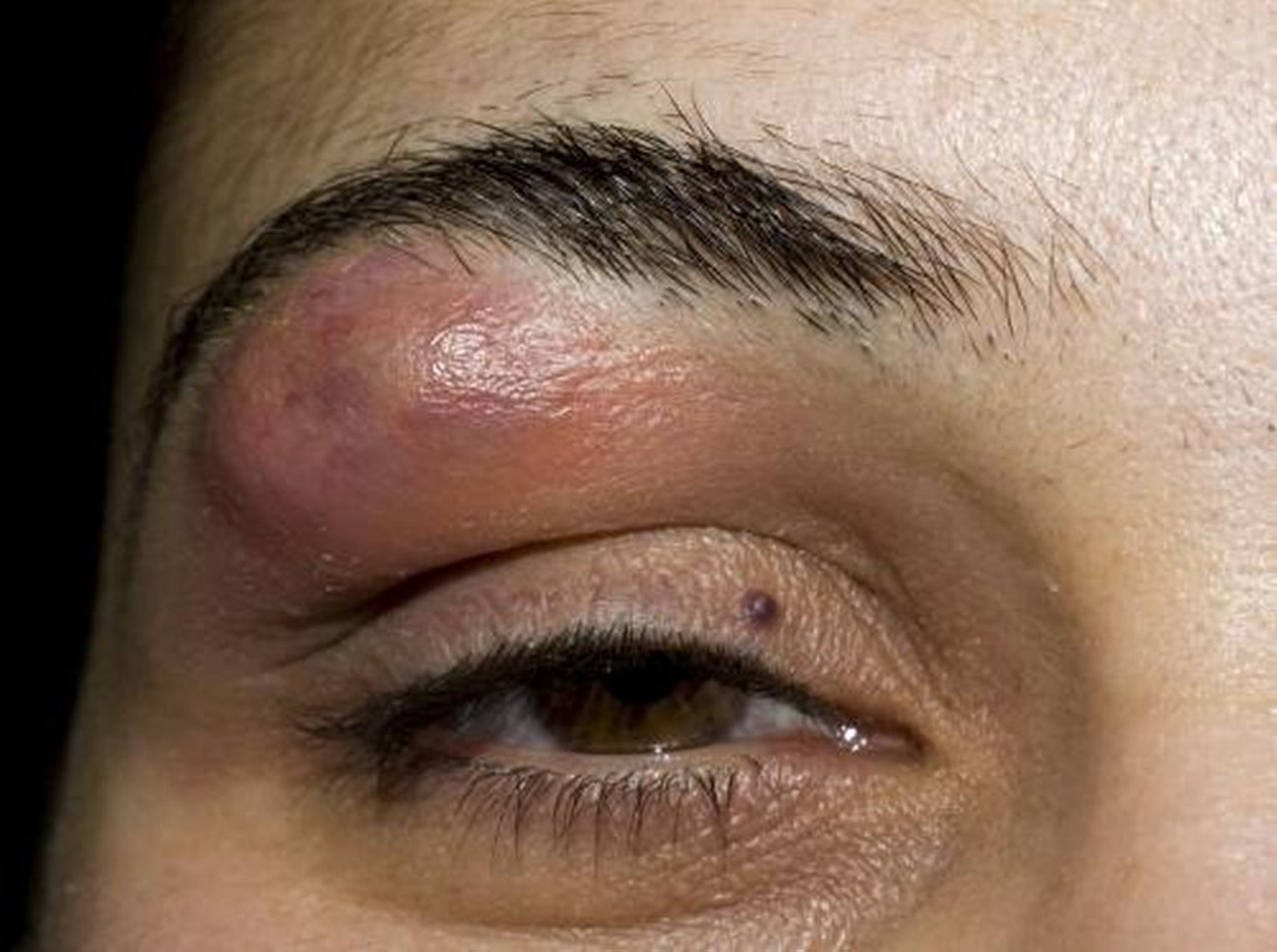 눈썹 아래의 종기