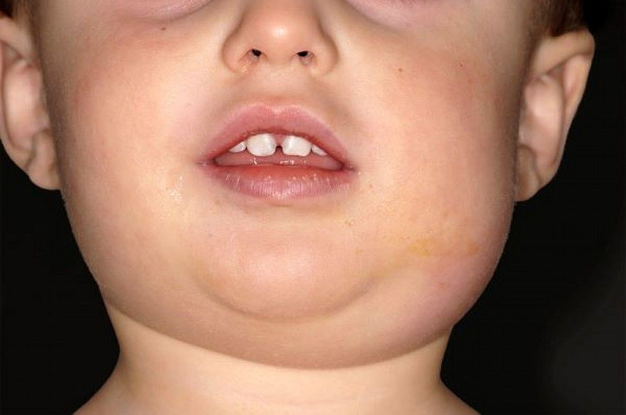 Mumps Parotitis