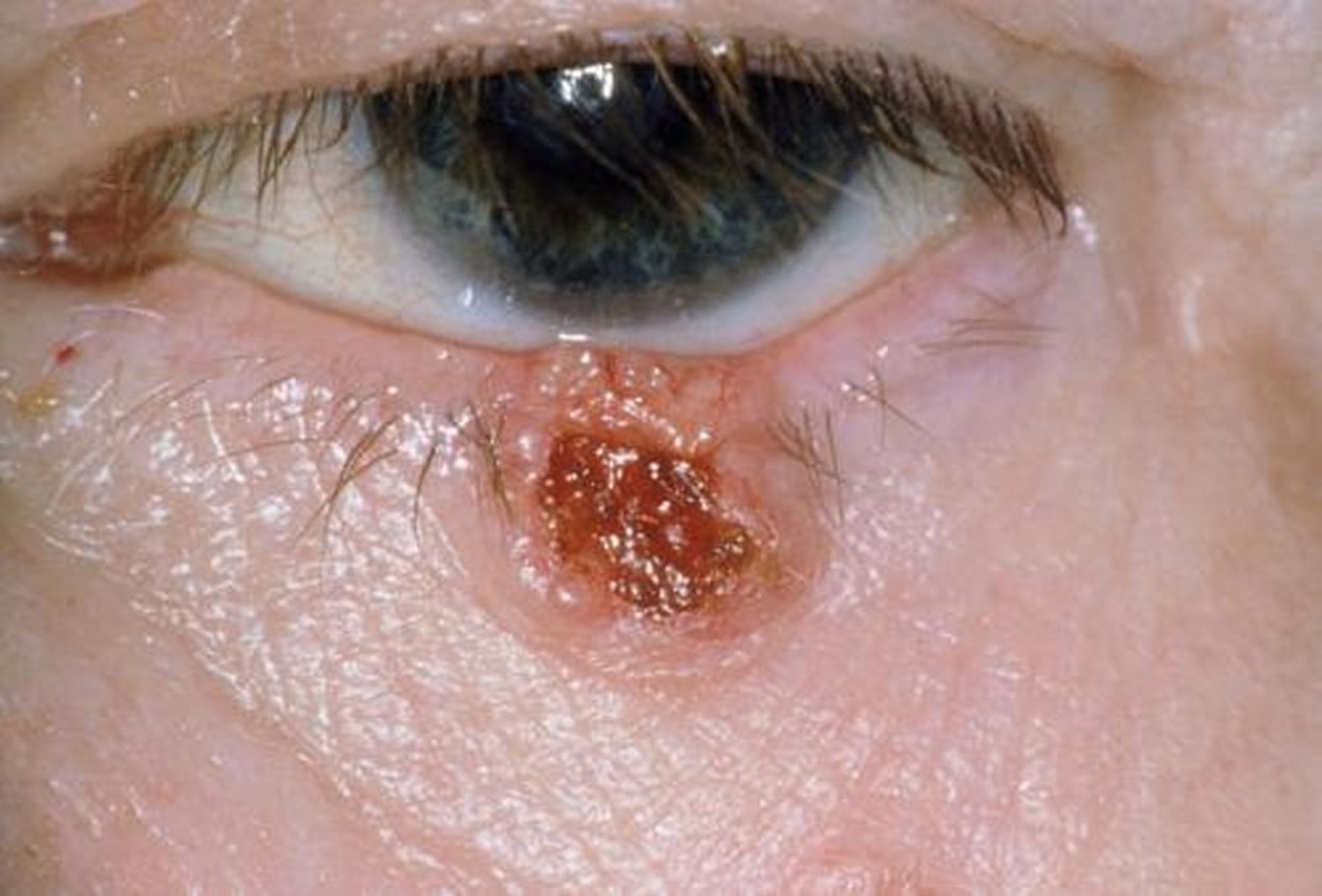 Carcinoma basocelular del párpado