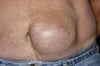 Hernia incisional