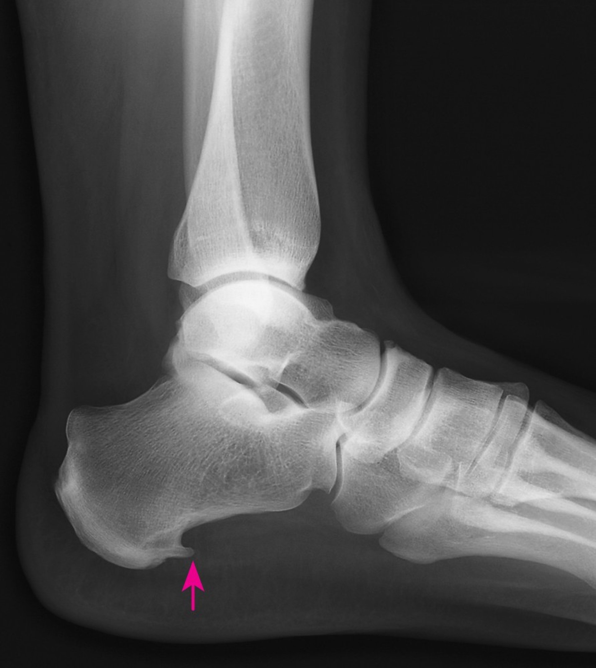 Heel Spur