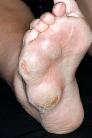 रूमैटॉइड नोड्यूल्स (पैर)