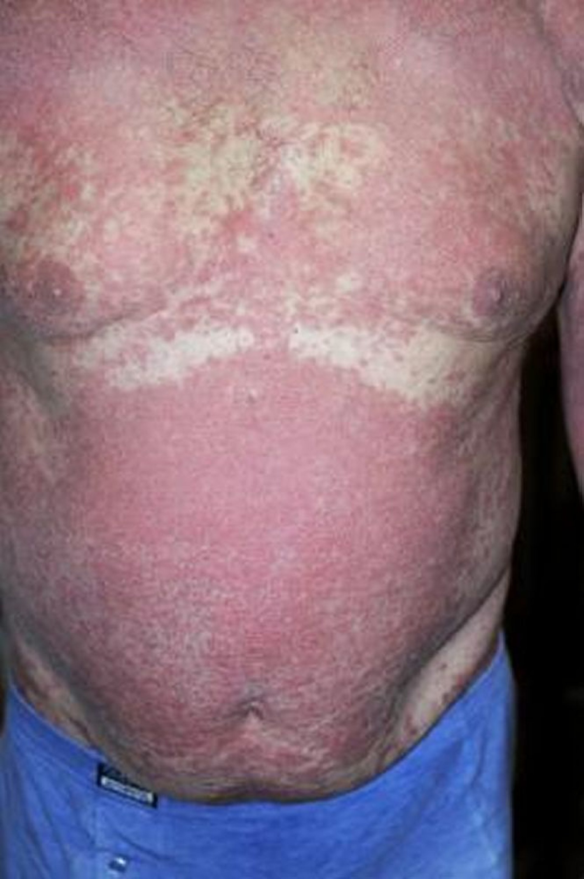 Psoriasis eritrodérmica