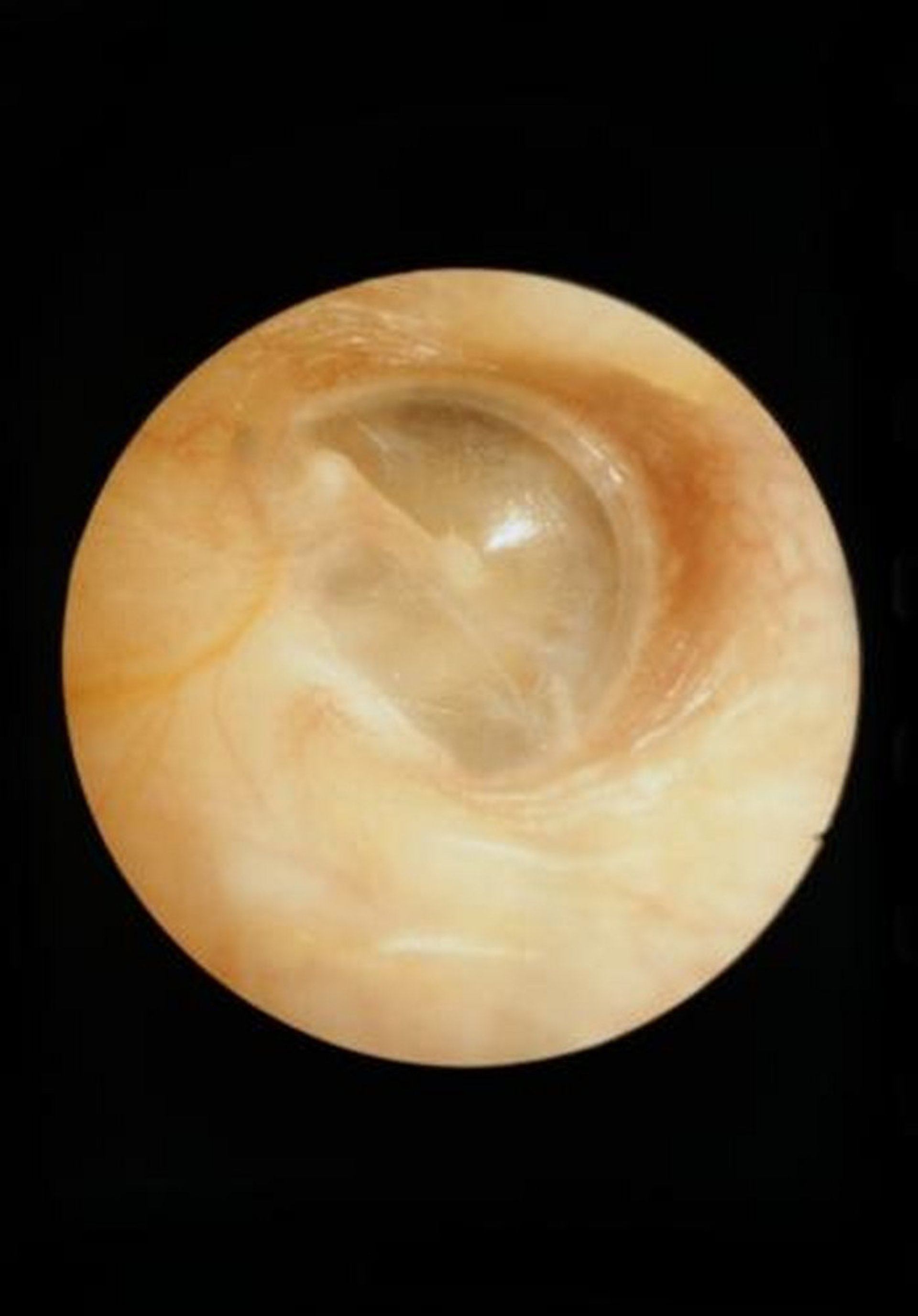 Normal Eardrum