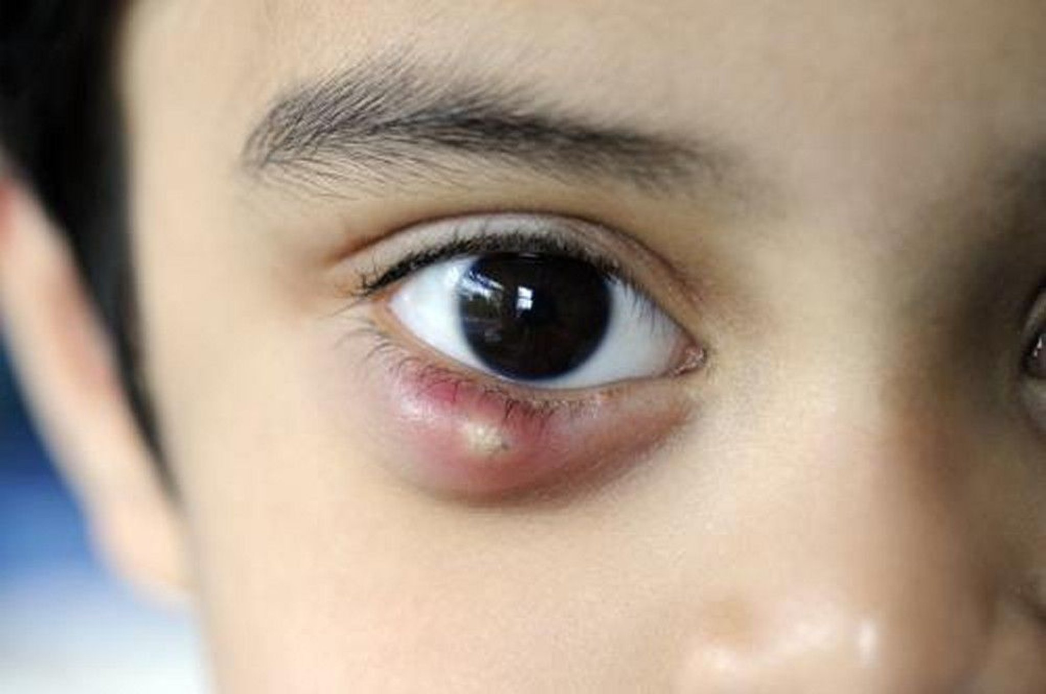 Chalazion