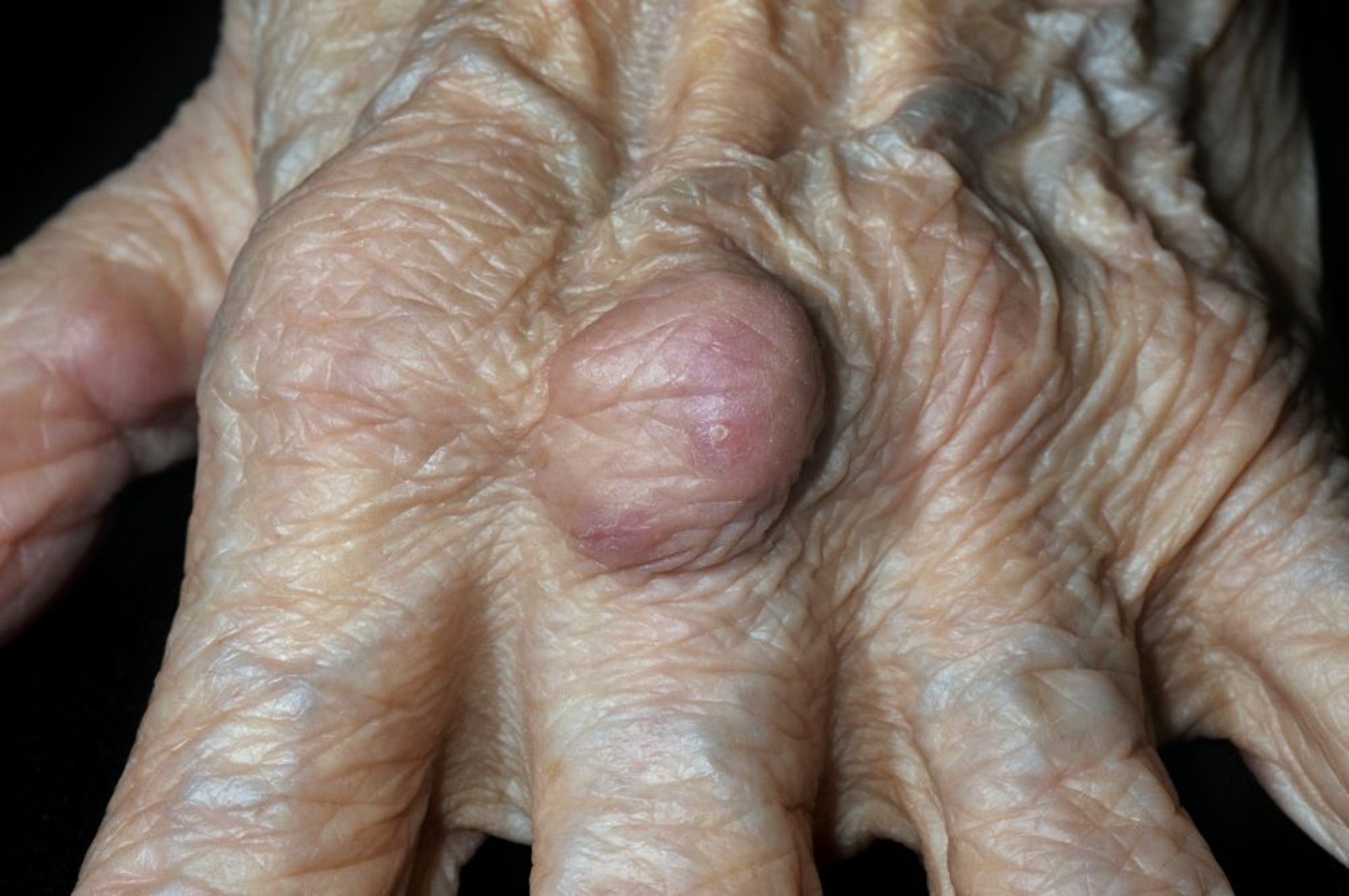 Nodule rhumatoïde (main)