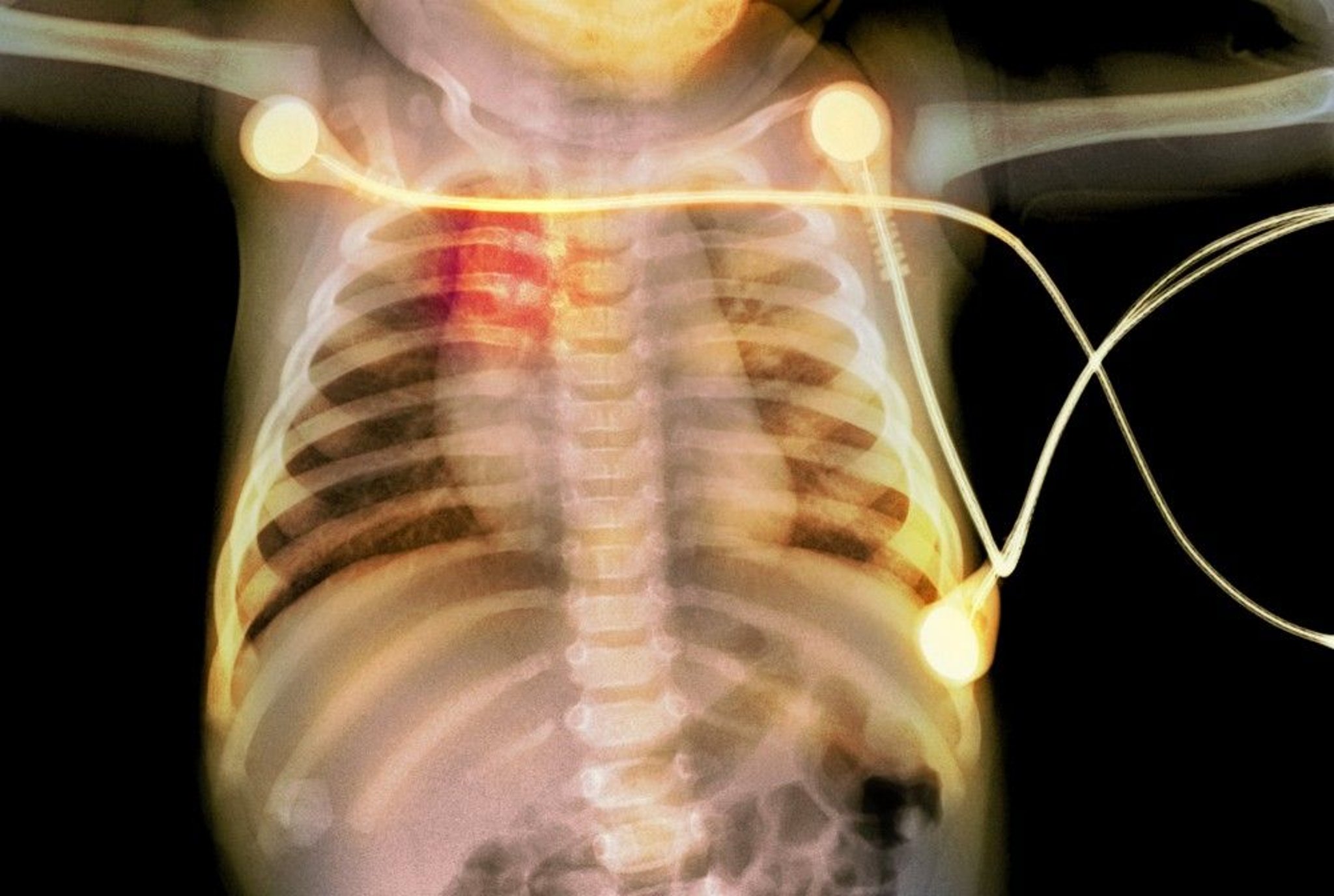 Rib Fractures in a Baby