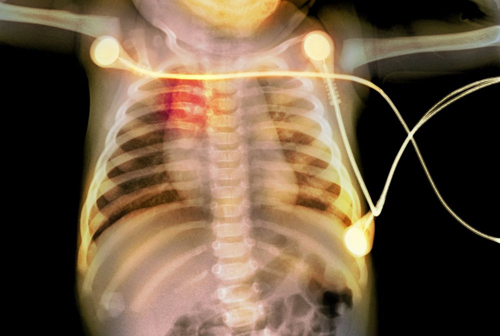 Fracturas costales en un bebé