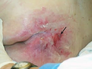 Úlcera de decúbito em estágio II (nádegas)