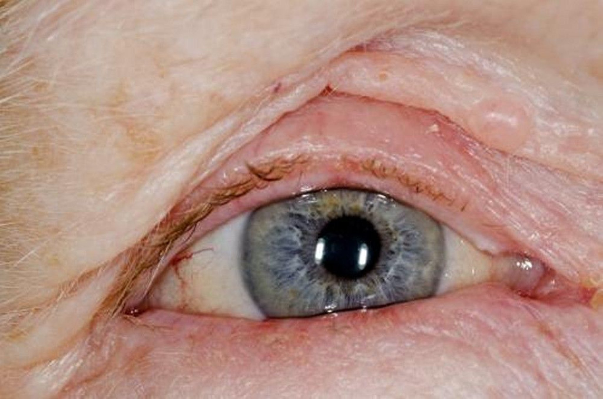 Chronic Blepharitis