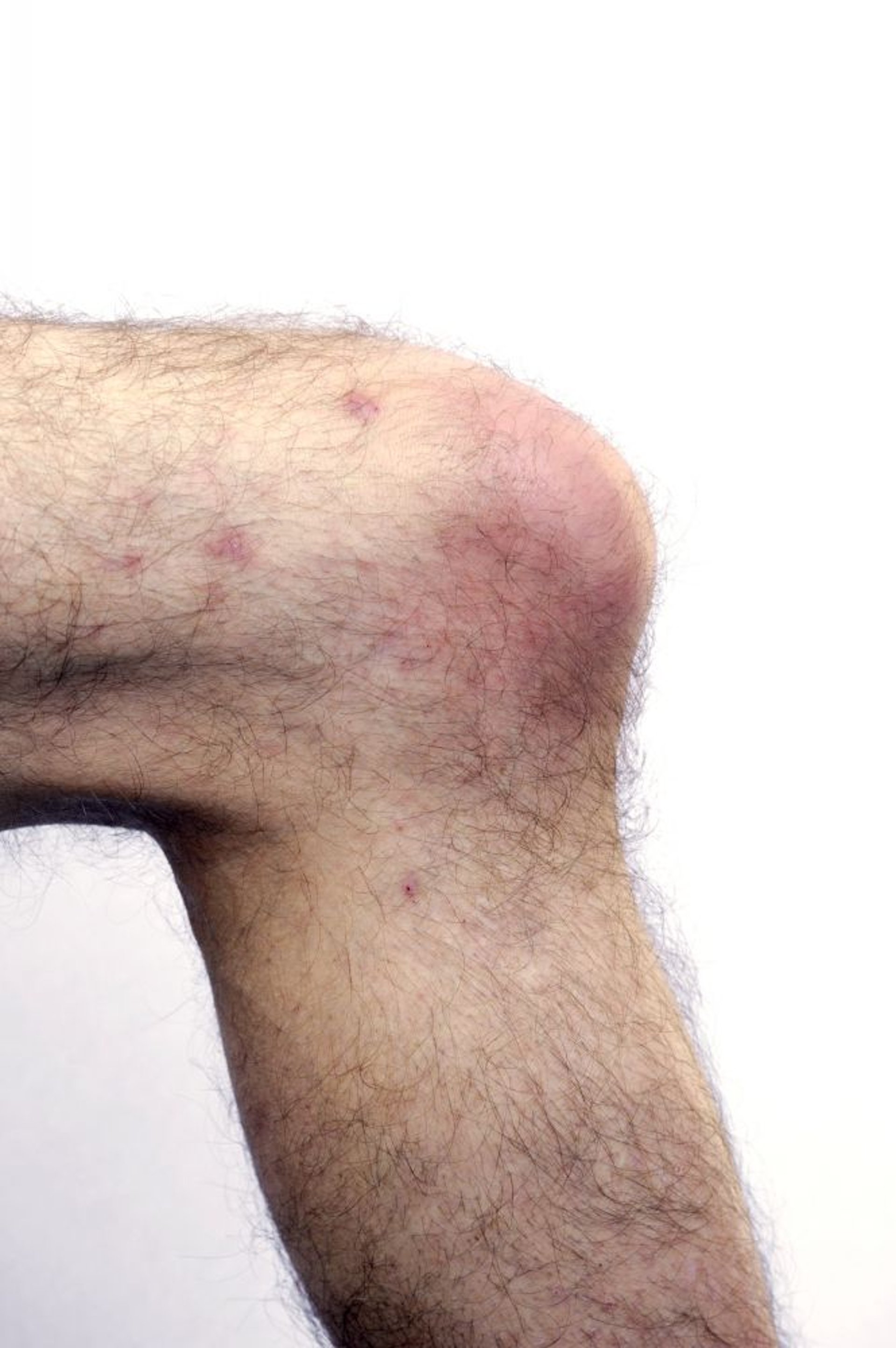 Bursitis de la rodilla