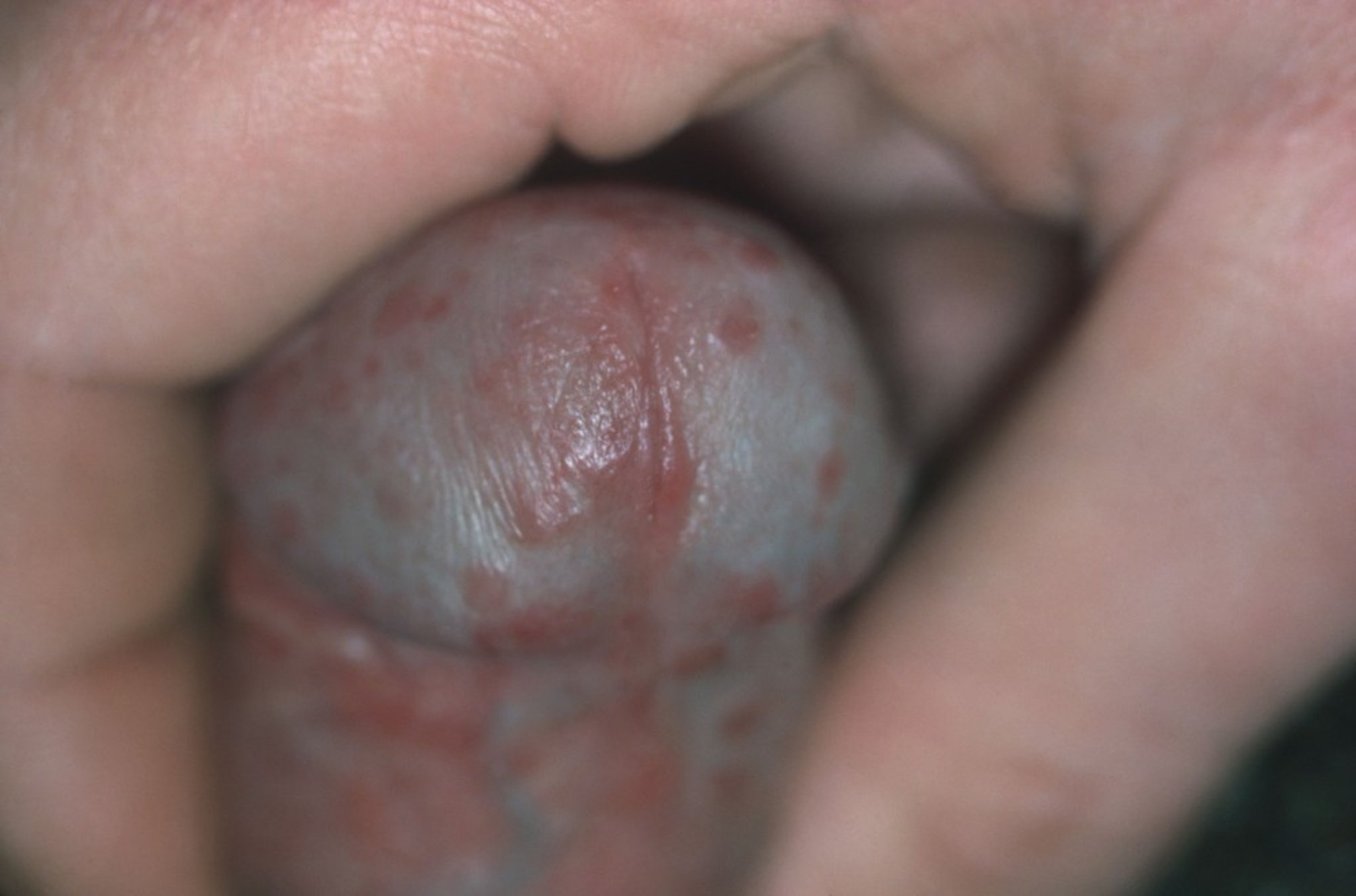 Penile Squamous Cell Carcinoma in Situ (Formerly Bowen Disease)