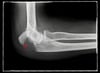 Fracture de l’olécrane avec déplacement