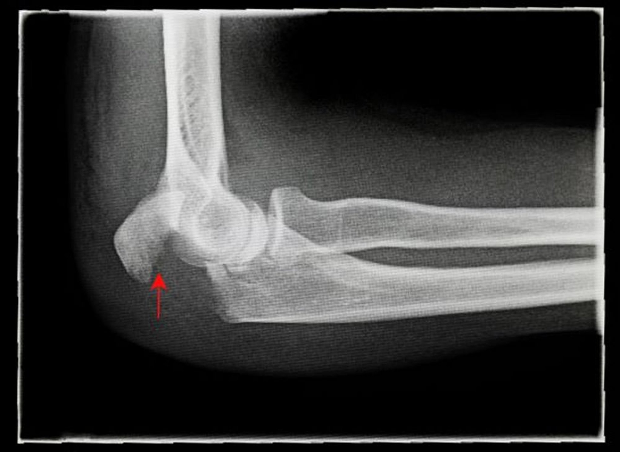 Fracture de l’olécrane avec déplacement