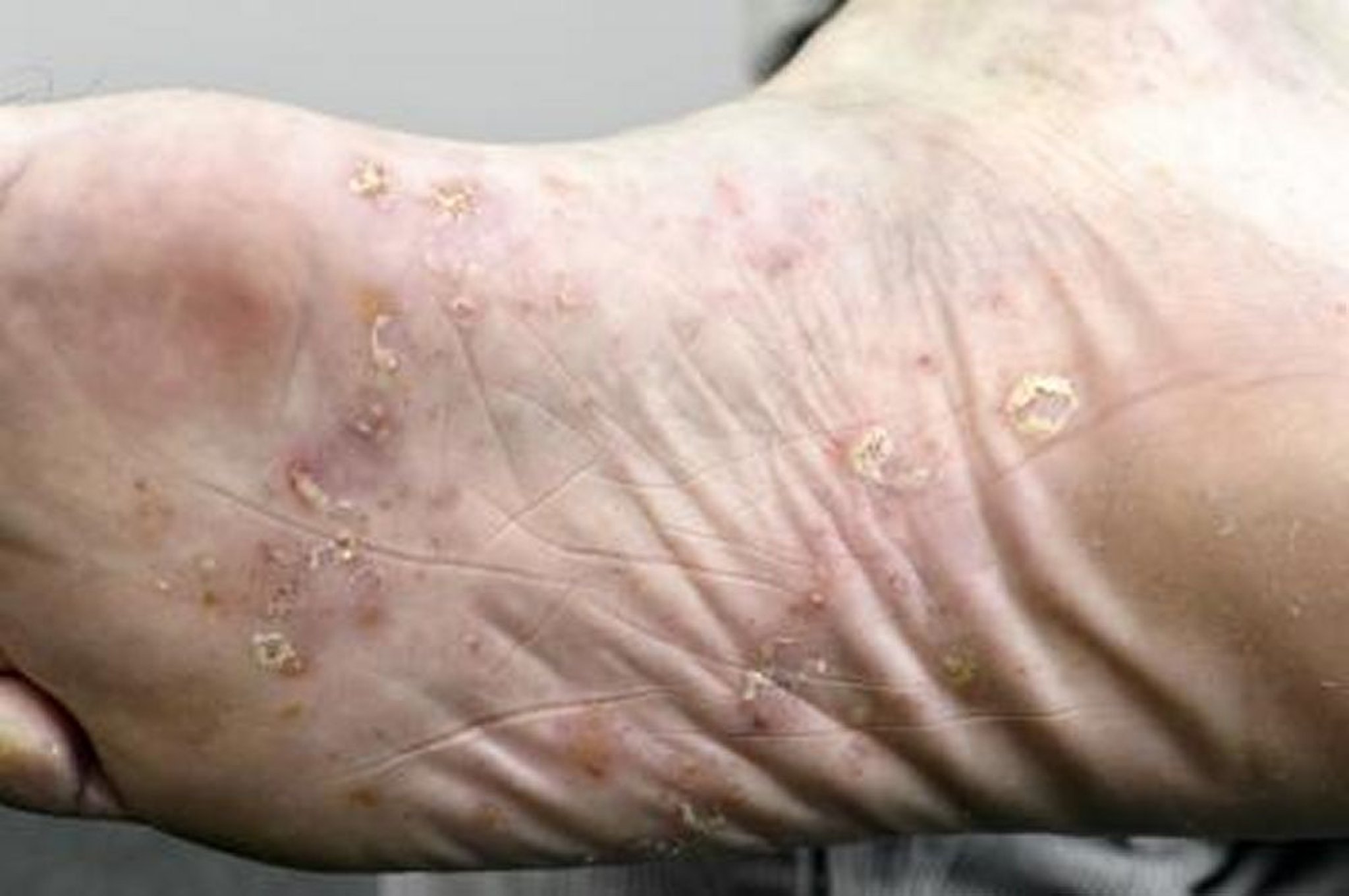 Psoriasis palmoplantar de la planta del pie