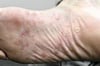 Psoríase palmoplantar da região plantar