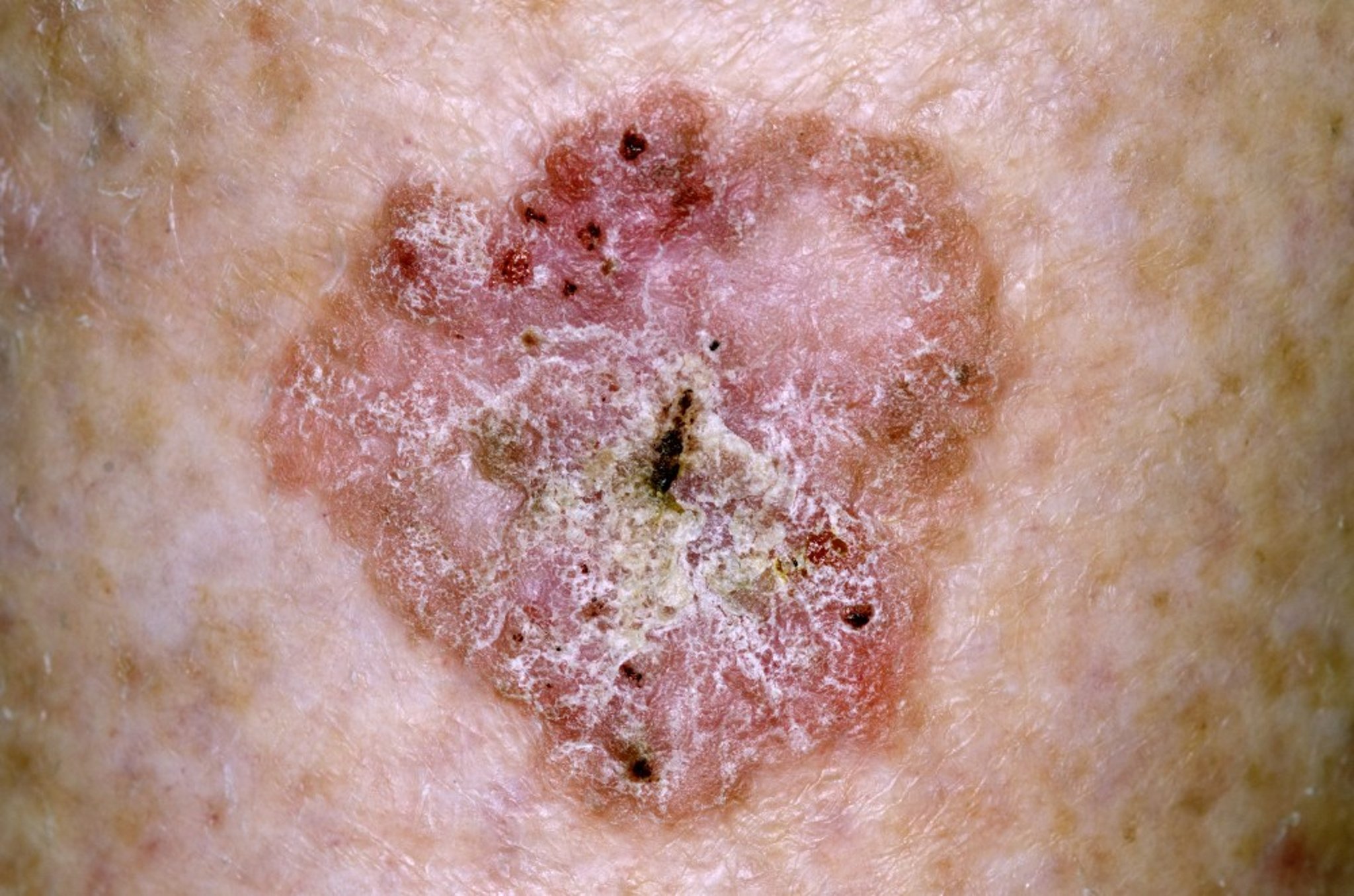 Squamous Cell Carcinoma in Situ (Shin)