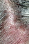 Psoriasis of the Scalp