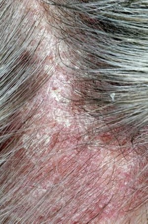 Psoriasis an der Kopfhaut