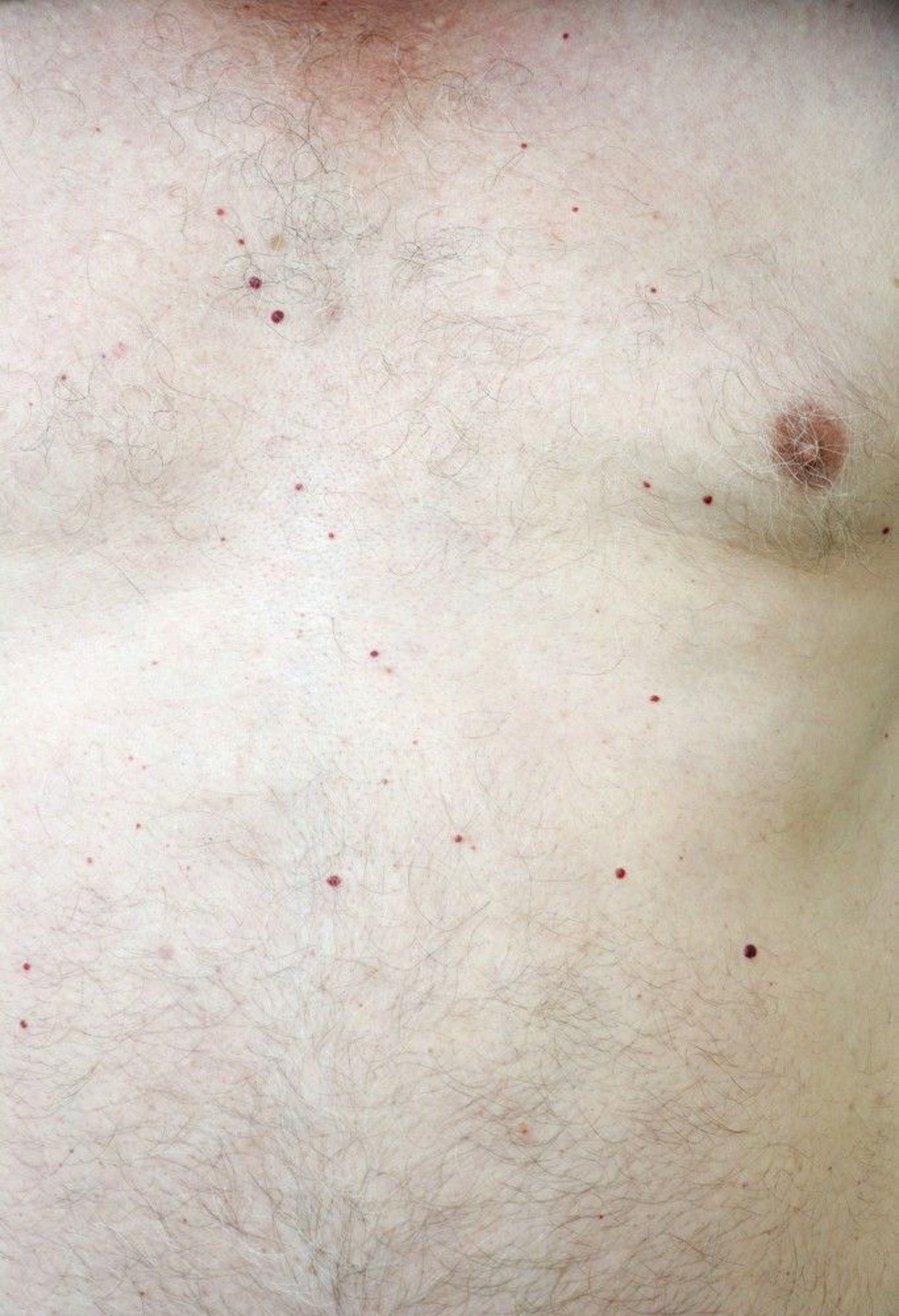 Cherry Angiomas