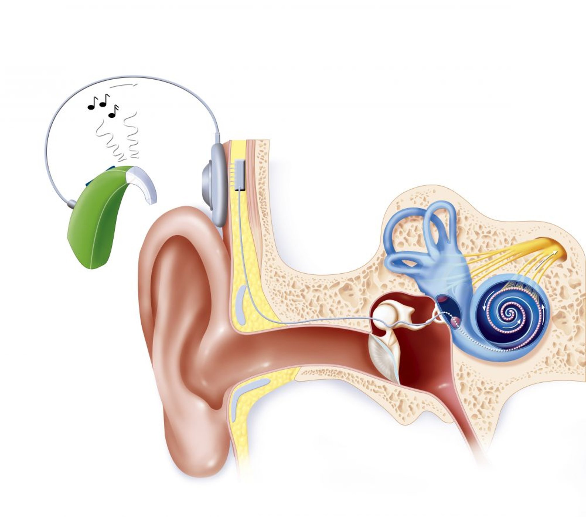 Implant cochléaire