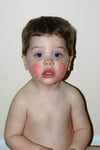 Rash Caused by Erythema Infectiosum