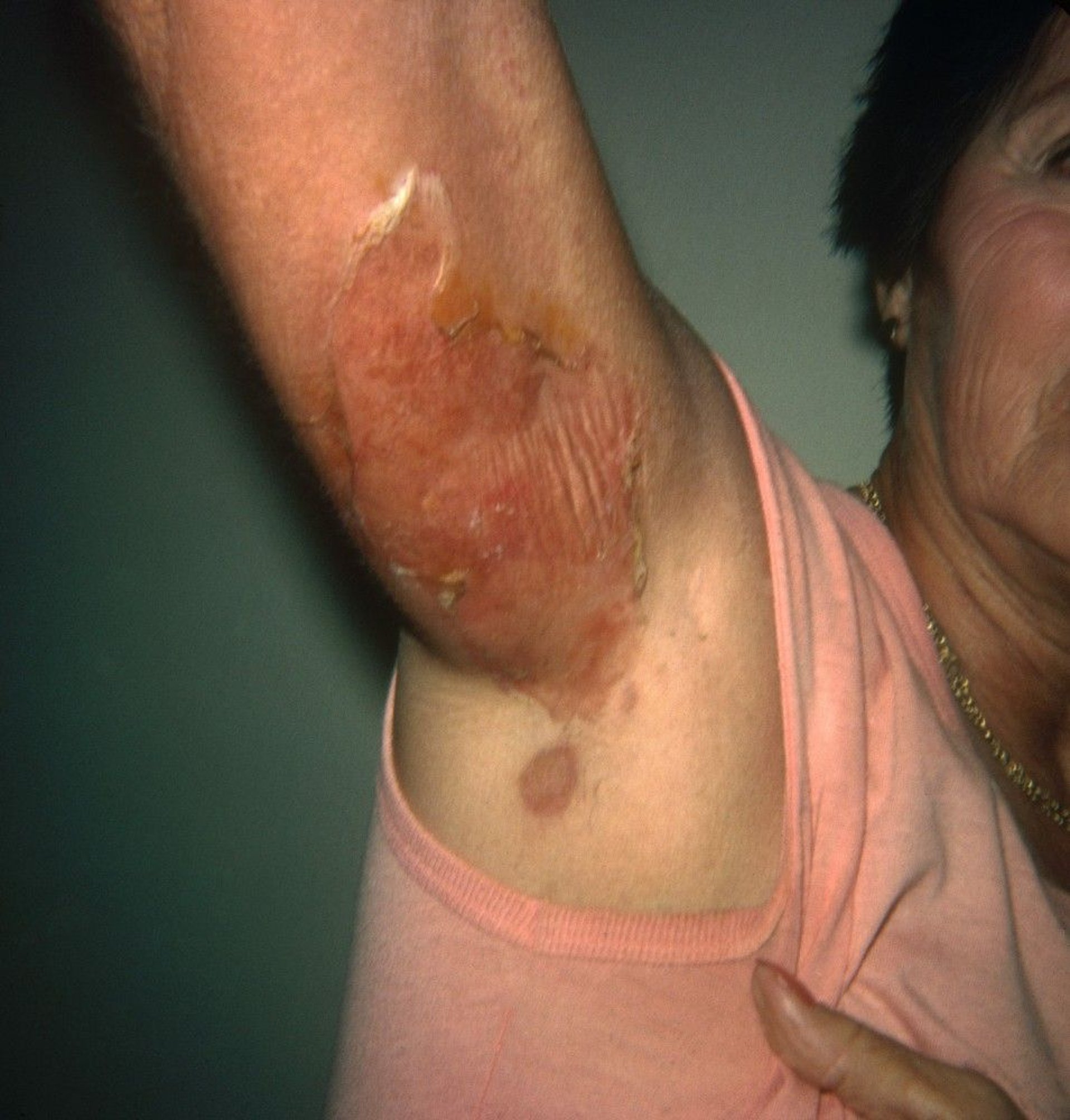 Staphylococcal Scalded Skin Syndrome (Adult)