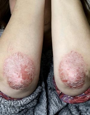 Psoriasis an den Ellenbogen