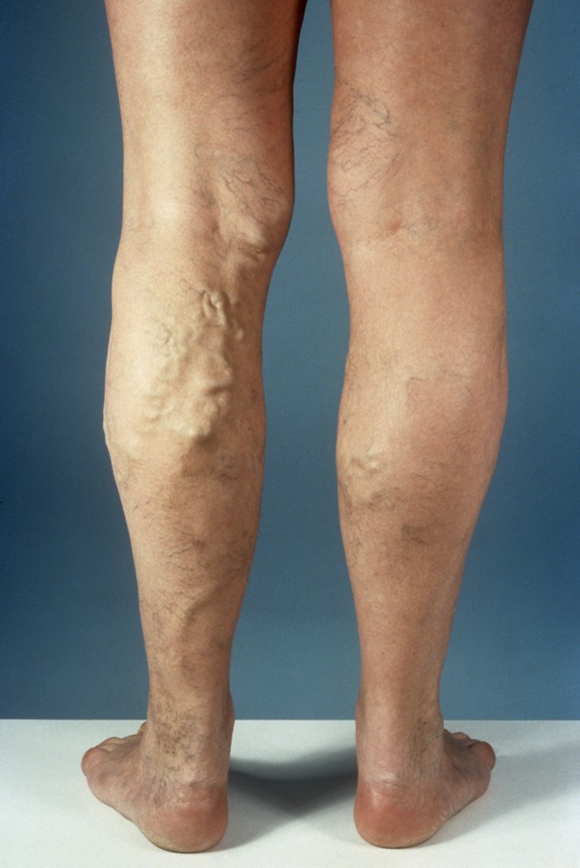 Varicose Veins of the Leg