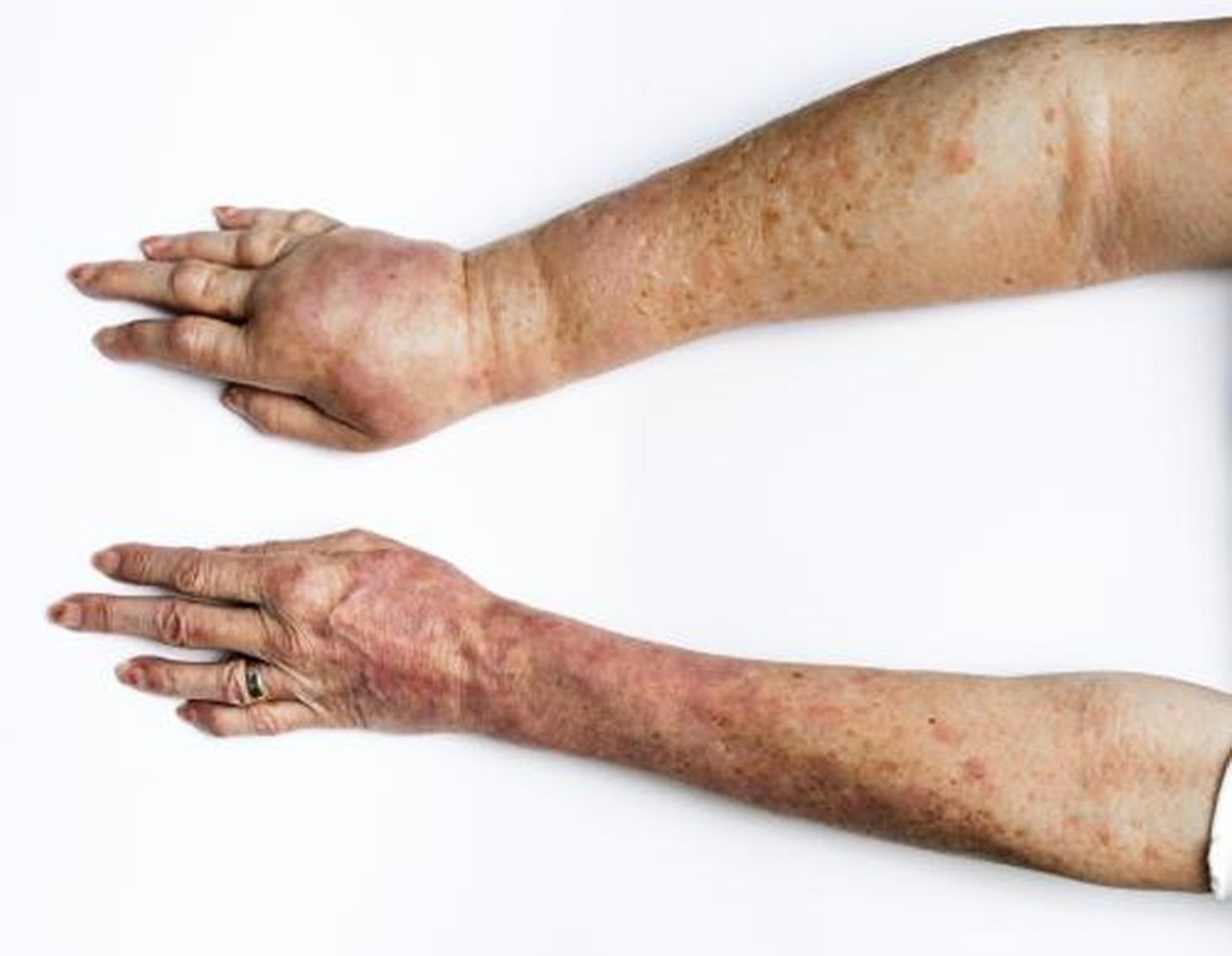 लिम्फेडीमा