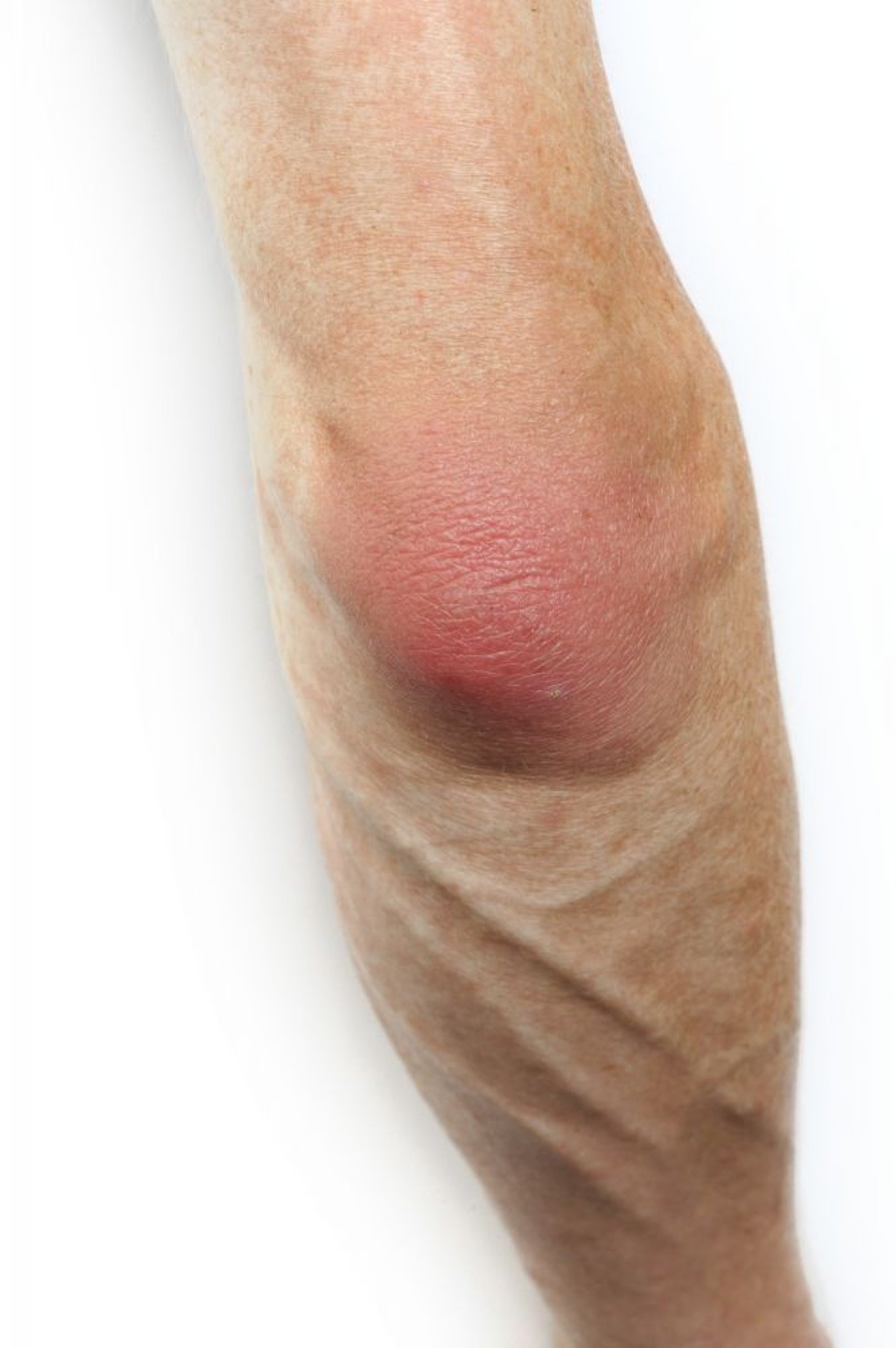 Bursitis (codo)