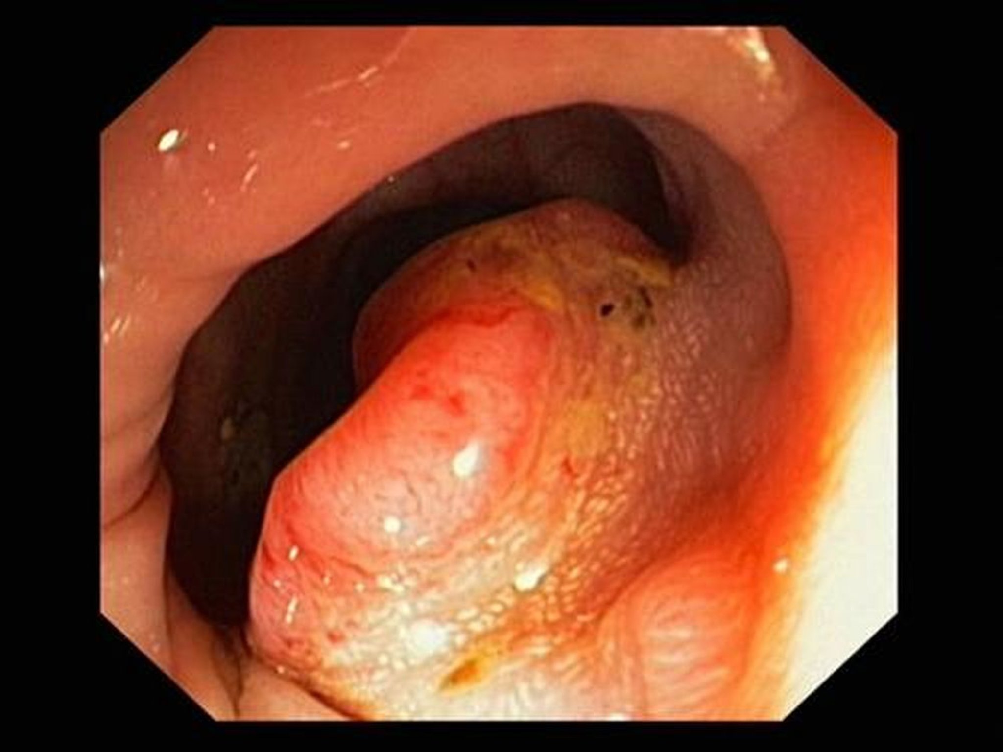 Cancer colorectal (coloscopie)