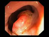 大腸がん（大腸内視鏡検査）