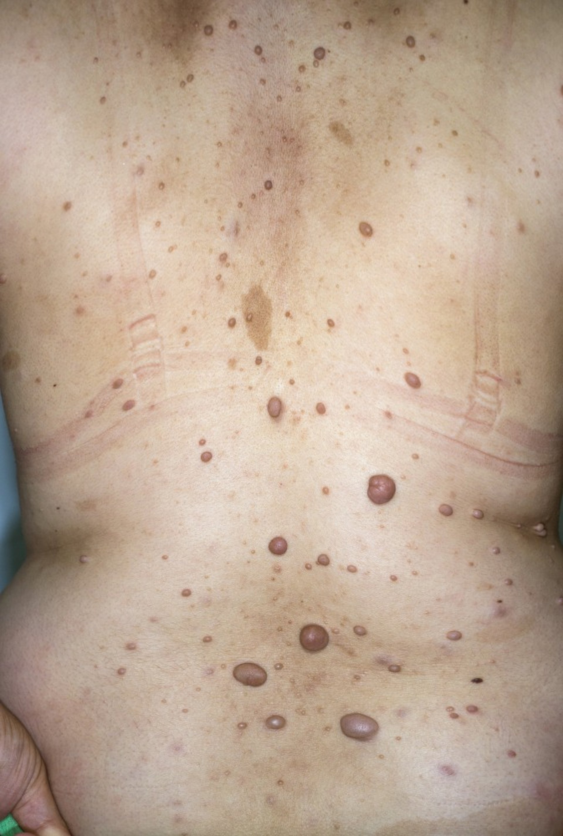 Neurofibromas and Café-au-Lait Spots