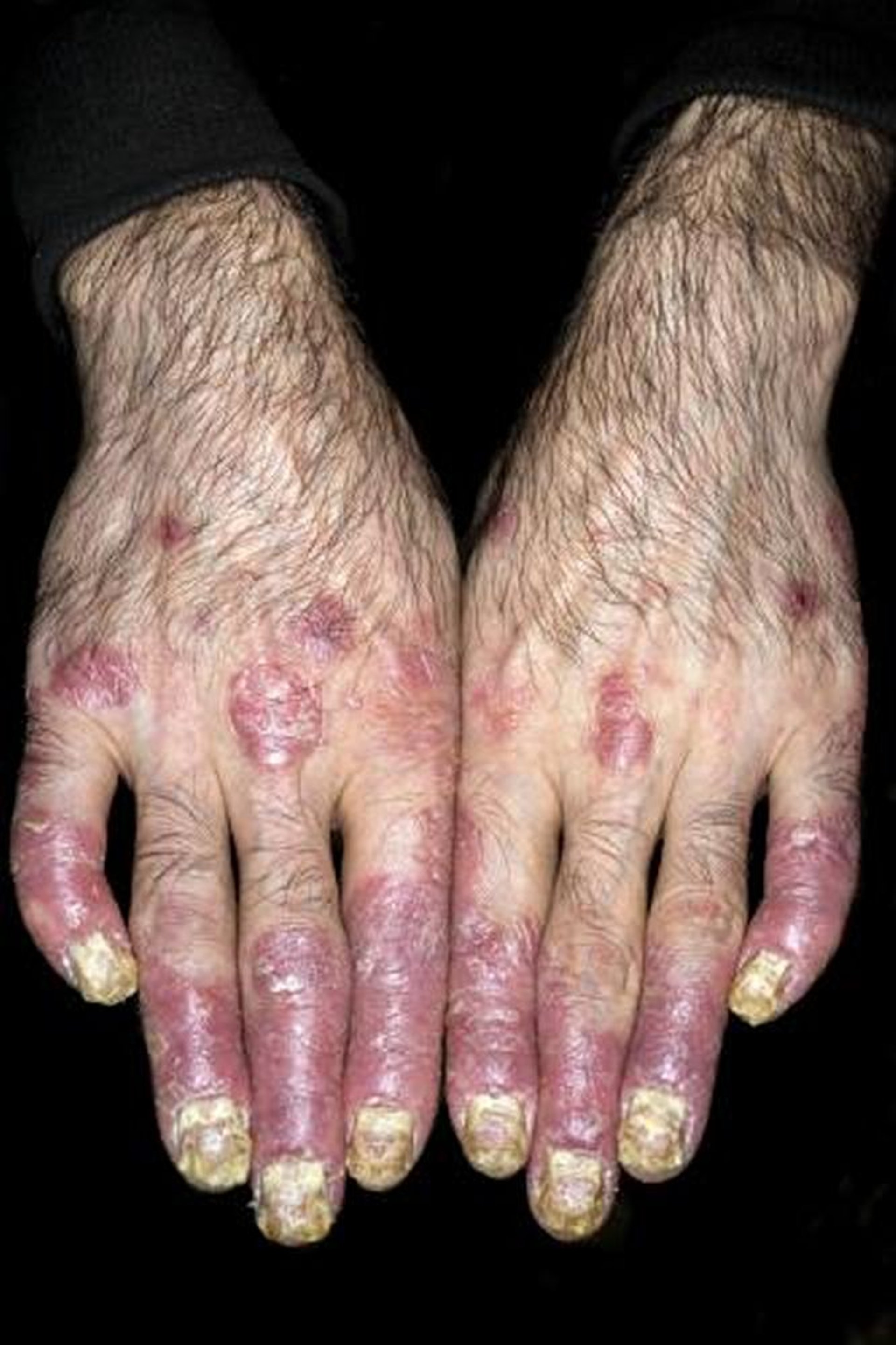 التهاب المفاصل الصدفي في أصابع اليد
