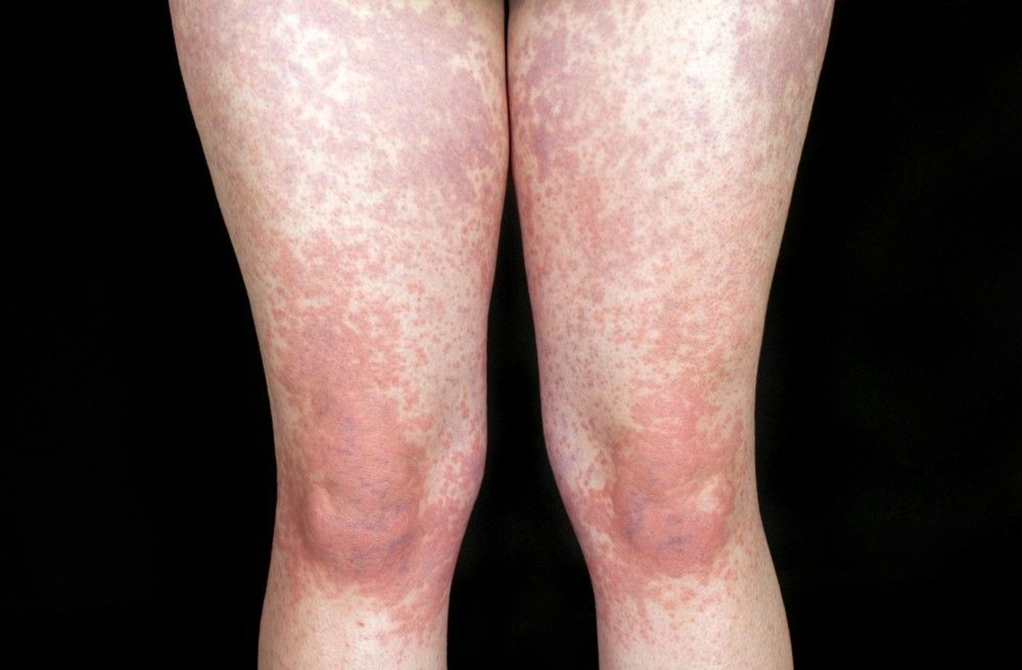 Rash Caused by Infectious Mononucleosis