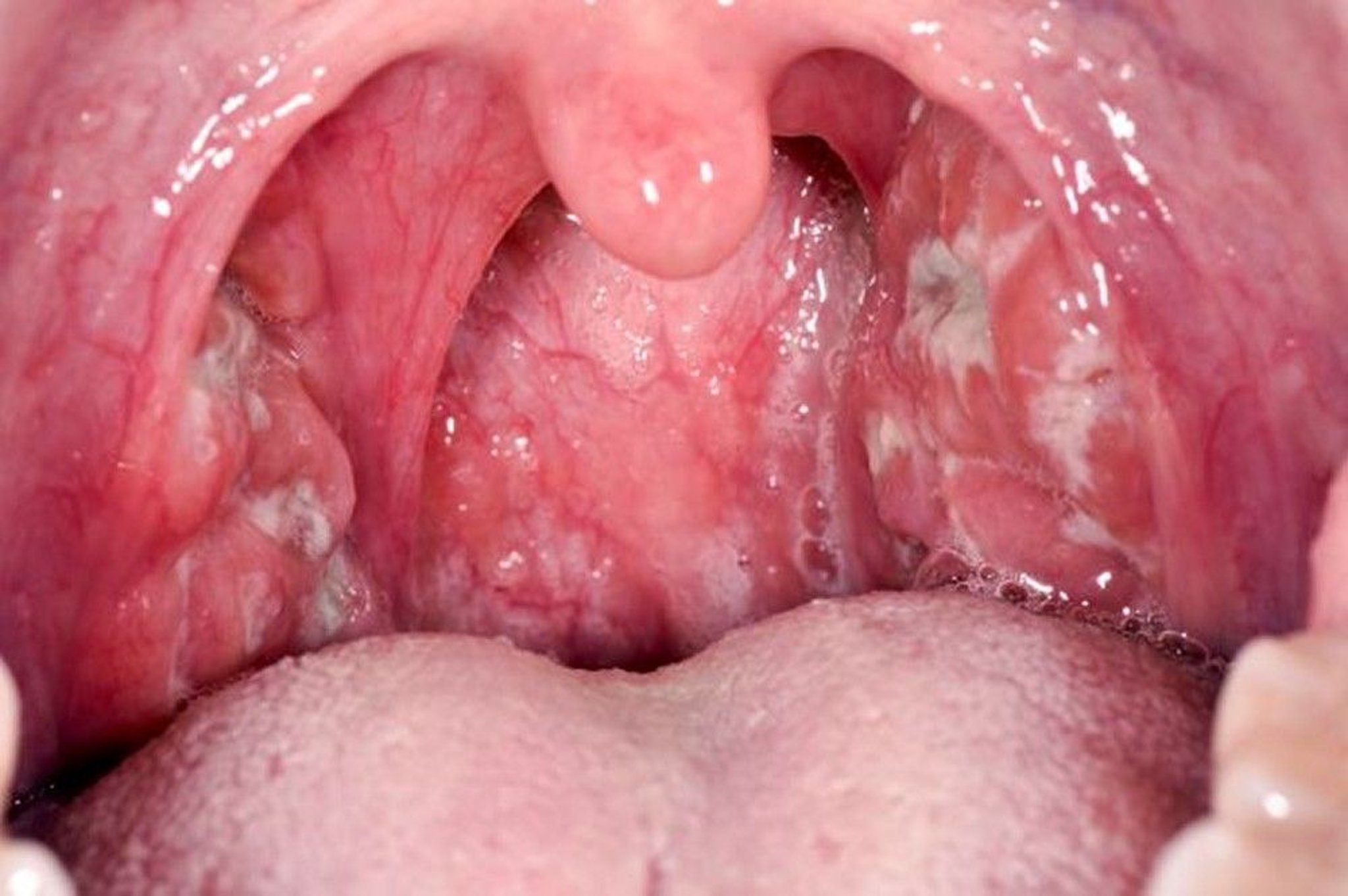 Tonsillitis
