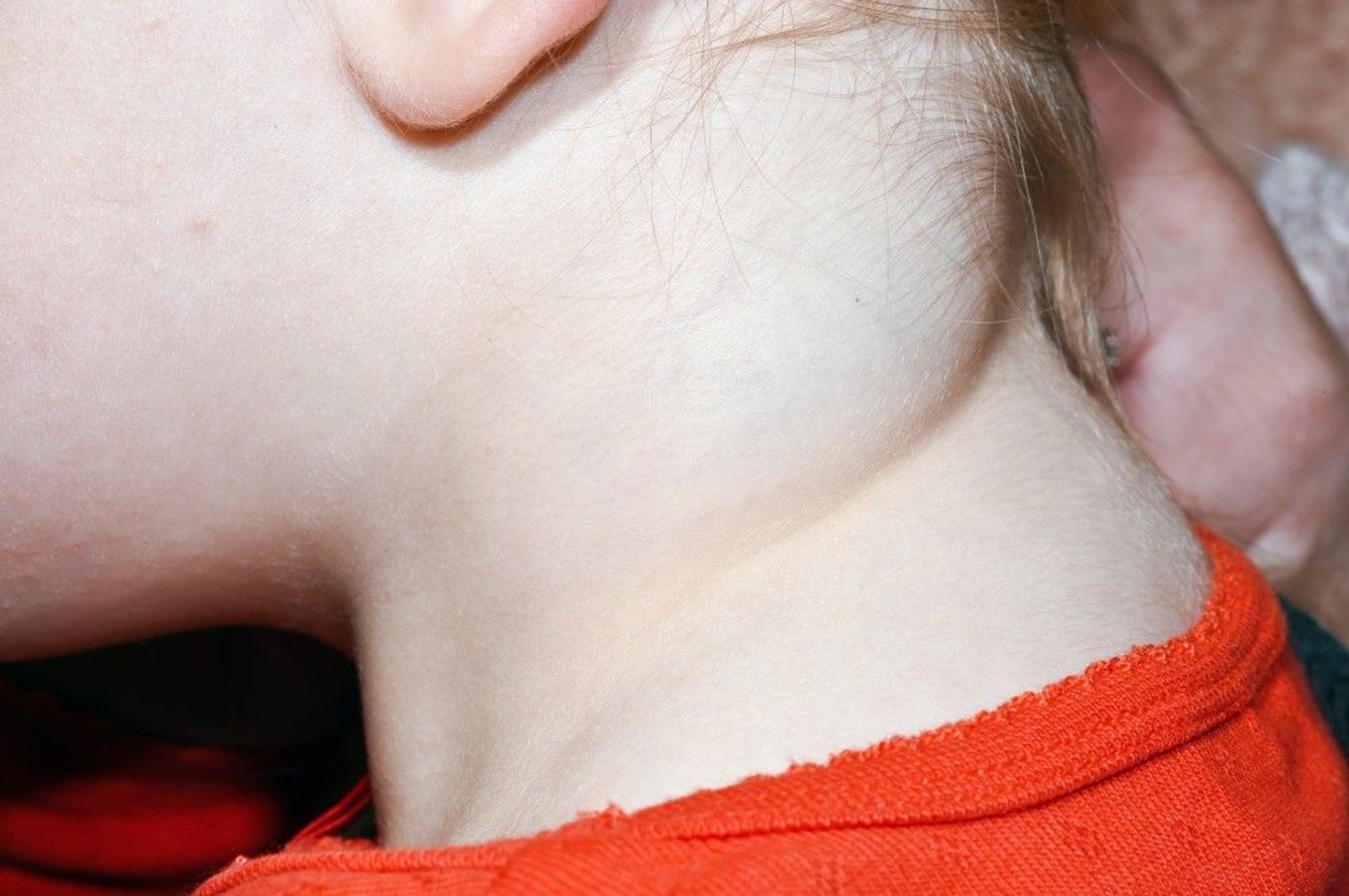 Lymphangioma