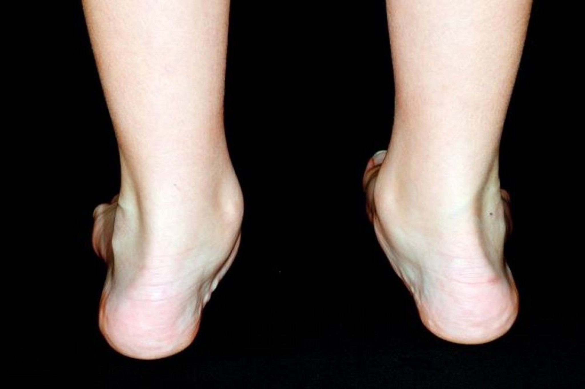Flat Feet (Pes Planus)